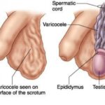 varicocele