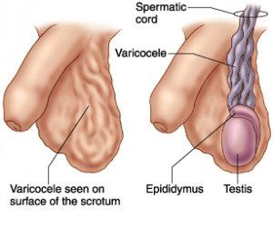 varicocele